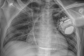 Nem csak orvosi, emberi bravúr is az, ahogyan egy fiatal életét megmentették a csíkszeredai kórházban