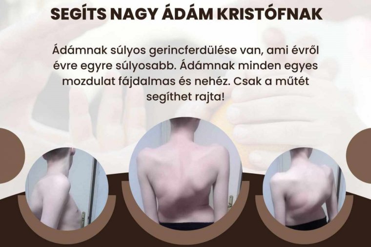 Súlyos hátgerinc-rendellenességgel küzdő fiú műtétjére gyűjtenek