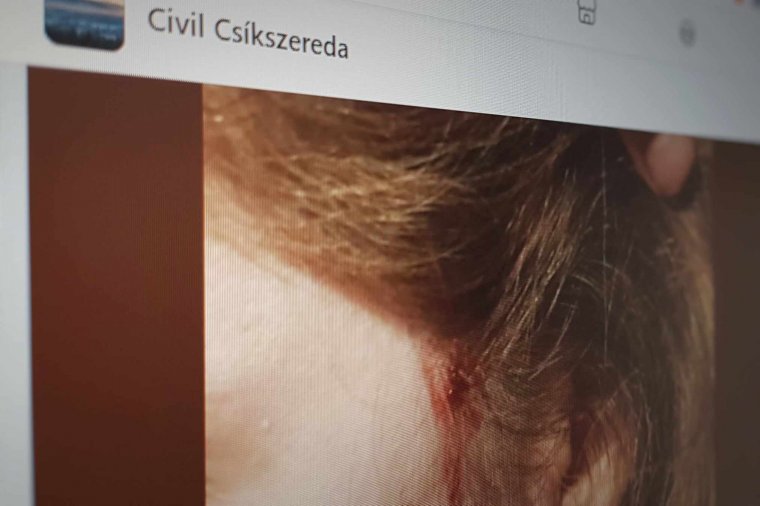 Egymást követik a támadások Csíkszeredában a nyílt utcán
