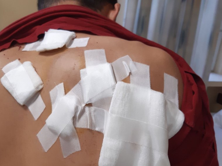 Fiatal fiút marcangolt össze egy medve – az áldozat nyilatkozott lapunknak