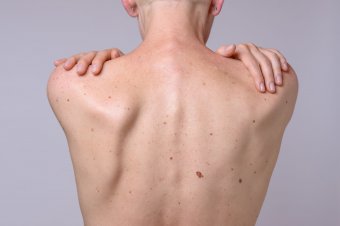 A melanóma elég ijesztő ahhoz, hogy a szűrést igénybe vegyék az emberek