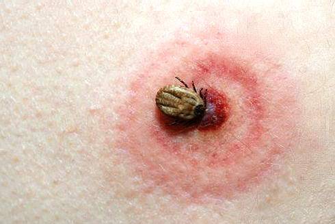 Kullancscsípés: teendők és téveszmék