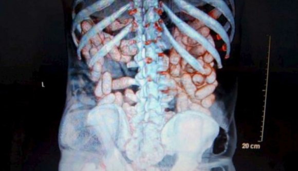 Két kiló kokaint csempészett volna be a gyomrában két brazil