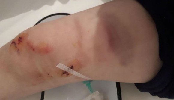 Kilencéves kisfiút sebesített meg egy medve Homoródremetén