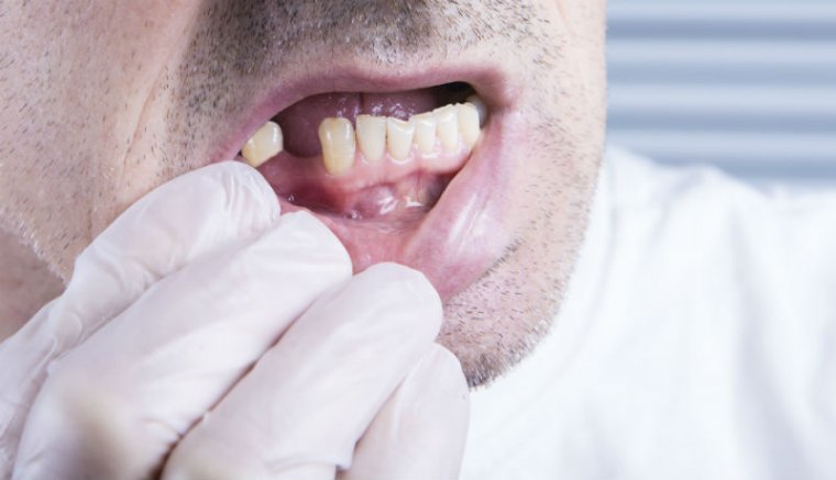 El tudja képzelni, hogy sok olyan ember él Romániában, aki még sohasem mosott fogat?