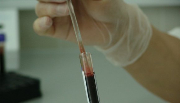 A hazai rákos betegek 70 százalékának esélye sincs a sugárkezelésre, emiatt rengetegen halnak meg