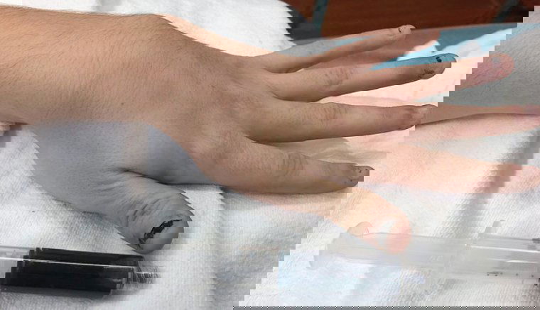 Kékké változott egy nő vére a túl sok fájdalomcsillapítótól