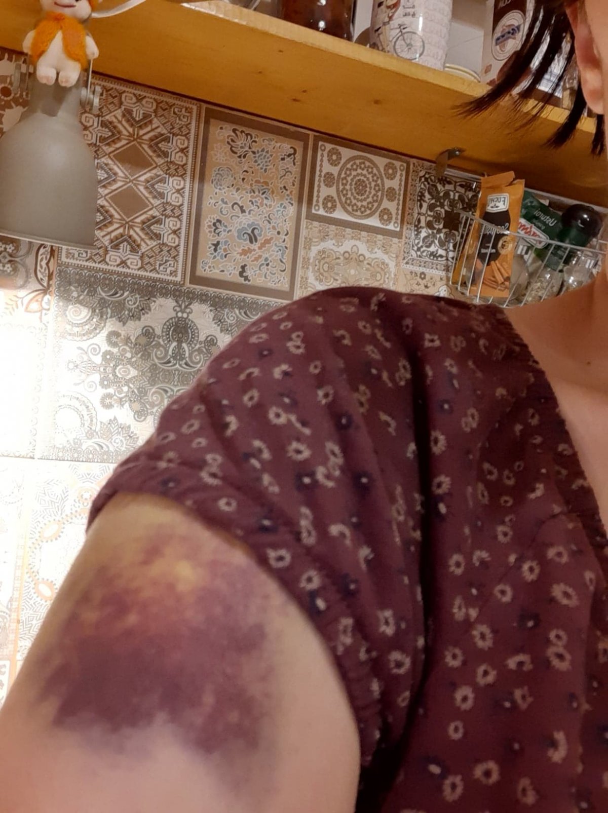 Parászka Boróka két évvel ezelőtt posztolt fotót véraláfutásos karjáról •  Fotó: Parászka Boróka/Facebook