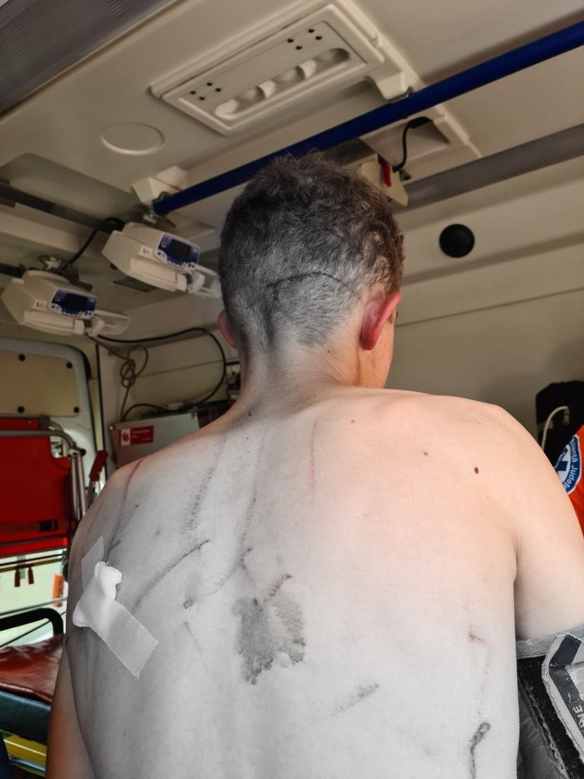 A fiatalember hátán és tarkóján is karmolások láthatóak •  Fotó: Facebook/borbolycsaba