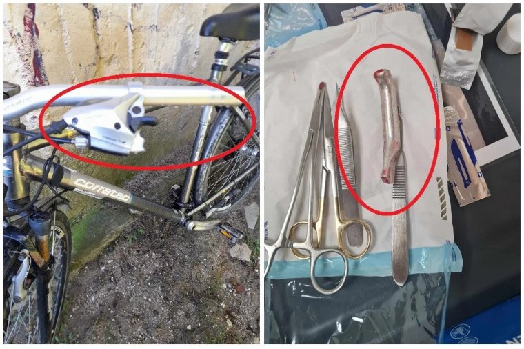 Kerékpáralkatrészt felejtett egy beteg lábában egy orvos az egyik romániai kórházban