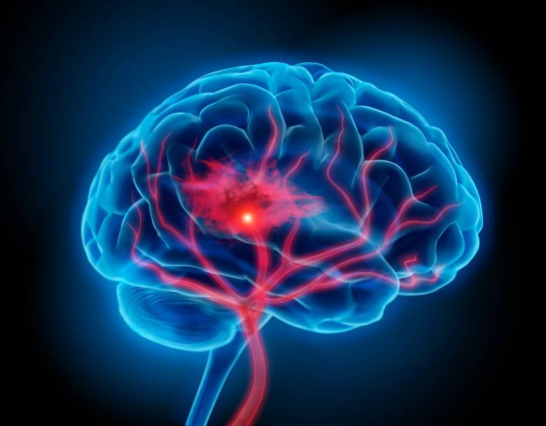Ilyen egy stroke-os agy. Súlyosak a következmények •  Fotó: strokelaw.com