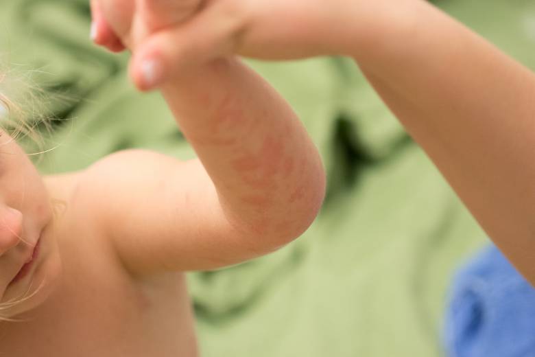 Egyre gyakrabban előforduló betegség az atópiás dermatitisz •  Fotó: Liget.ro