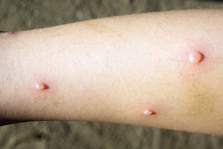 Jellegzetes, hólyagos kiütésekkel jár a megbetegedés •  Fotó: Wikipédia