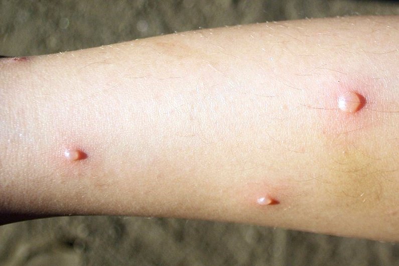 Jellegzetes, hólyagos kiütésekkel jár a megbetegedés •  Fotó: Wikipédia