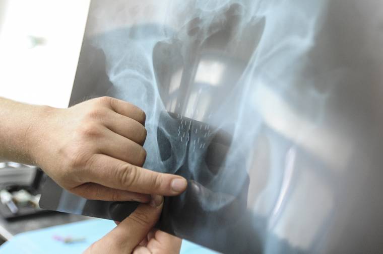 Kíméletesen kezelik a prosztatarákot