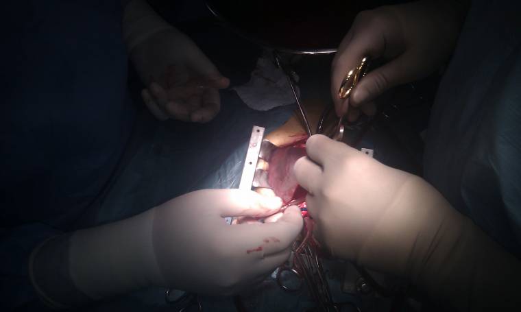 Először kapott ember génmódosított sertésszívet, a férfi három nappal a műtét után jól érzi magát